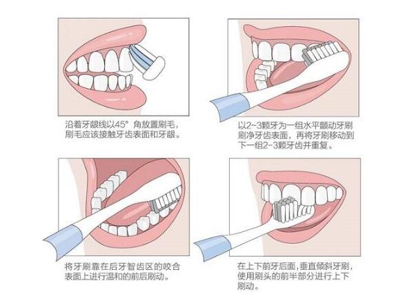 圓頭聲波電動(dòng)牙刷刷牙方法之巴氏刷牙法